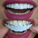 snap on smile