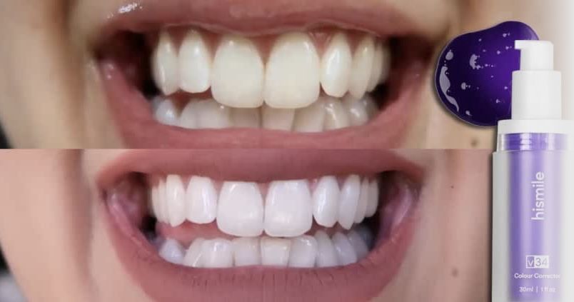 Hismile blanchiment